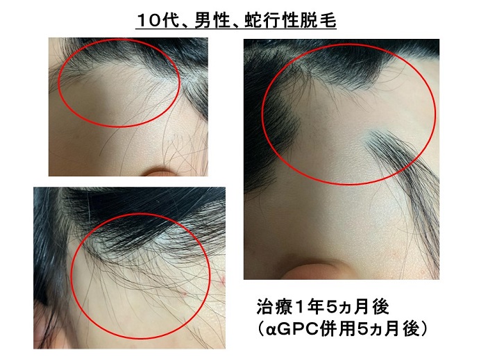 円形脱毛症　病院